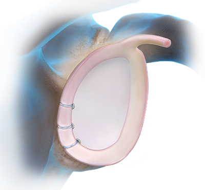 Knotless SutureTak® Anchor Technique - Posterior