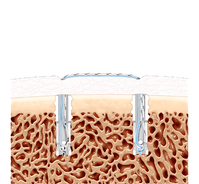 Knotless Corkscrew® Anchor Technique - Remplissage