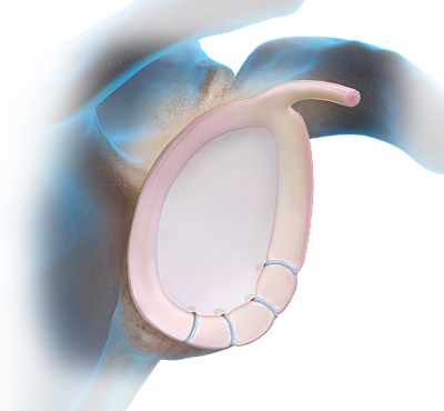 Knotless FiberTak® Soft Anchor Technique - Anterior