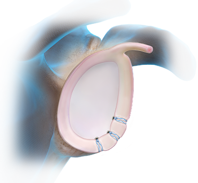 PushLock® Anchor Technique - Anterior