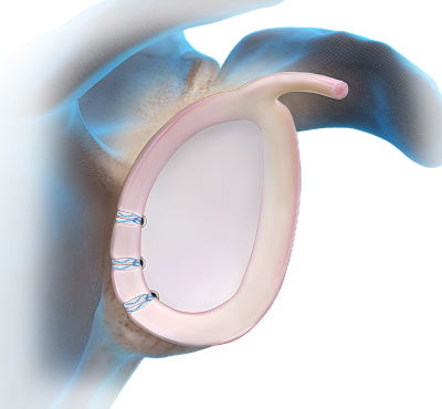 PushLock® Anchor Technique - Posterior