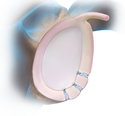 SwiveLock® Instability Technique - Anterior
