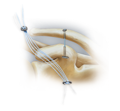 AC TightRope<sup>®</sup>  Technique