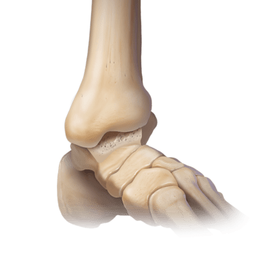 Osteoartritis del tobillo