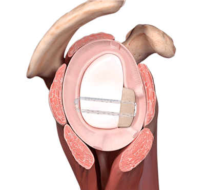 Bone Block Cerclage