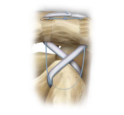 Chronic AC Joint Reconstruction Technique