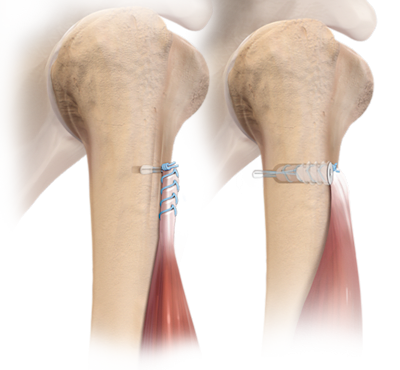 Técnica para tenodesis con FiberTak<sup>®</sup>