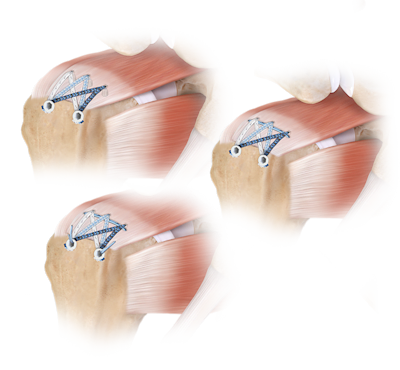 FiberTak® SpeedBridge™-Rotatorenmanschettenrekonstruktion