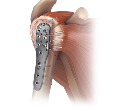 Humeral SuturePlate™ Repair