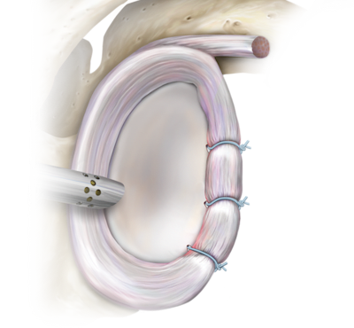Knot Tying Labral, Instability, ALPSA and HAGL Lesion Repair