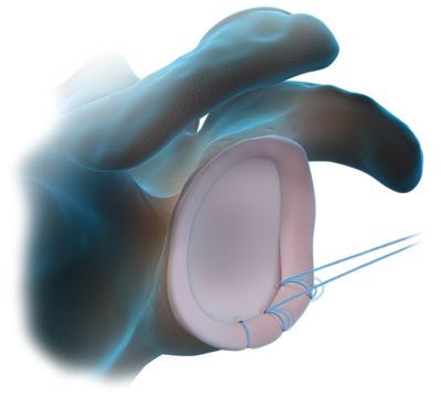 Técnica de ancla blanda FiberTak<sup>®</sup> sin nudos