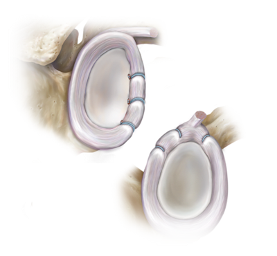Knotless Labral, Instability, ALPSA and HAGL Lesion Repair