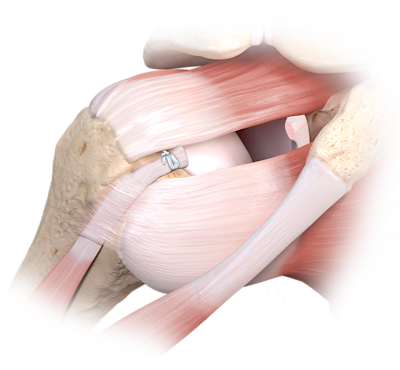 Loop 'N' Tack™ Biceps Tenodesis Technique