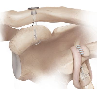 Técnica de tensión ajustable de bajo perfil para reparación acromioclavicular