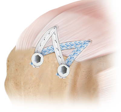 SpeedBridge™ Double-Row Technique