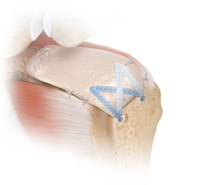 Superior Capsular Reconstruction (SCR) Technique