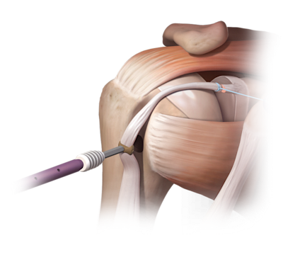 SwiveLock<sup>®</sup> Tenodesis Technique