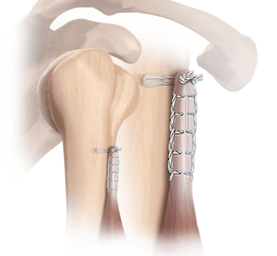 FiberTak<sup>®</sup> Biceps Tenodesis