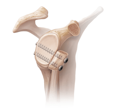 Glenoid Bone Loss