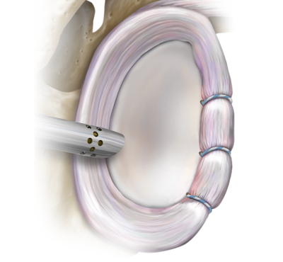 Knotless SutureTak<sup>®</sup>-Anker