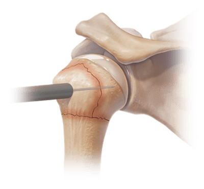 Perforación percutánea