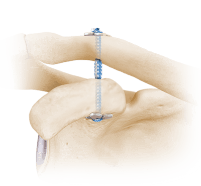 Cortical Button Fixation
