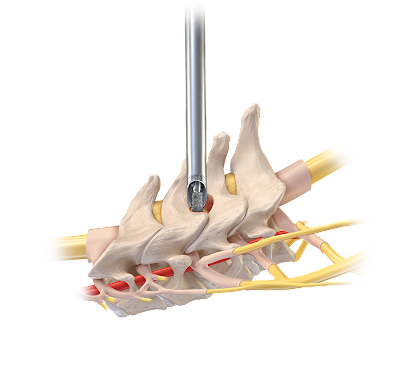 Cervical Foraminotomy and Decompression