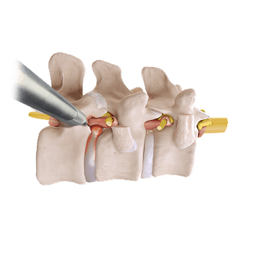 Endoscopic Thoracic Transforaminal Discectomy