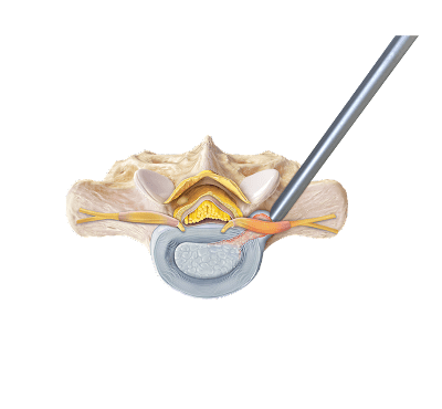 Endoscopic Far Lateral Transforaminal Lumbar Discectomy 
