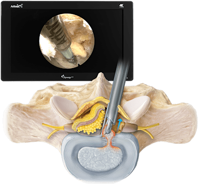 Interlaminäre endoskopische Diskektomie