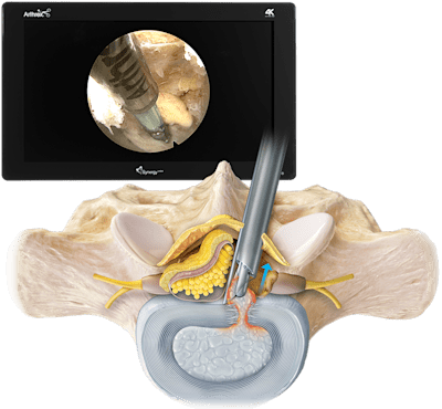 Interlaminar Endoscopic Discectomy