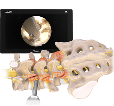 Durchtrennung des medialen Asts des Ramus dorsalis