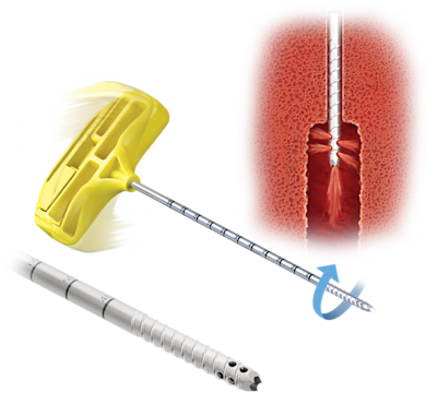 Vortex™-Nadeln mit Gewinde für den Heilungsprozess der Wirbelsäule