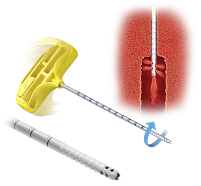 Agujas roscadas de recuperación Spine Vortex™