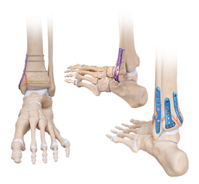 Sistema de titânio para fraturas de tornozelo 