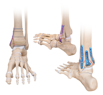 Sistema de titanio para fracturas de tobillo