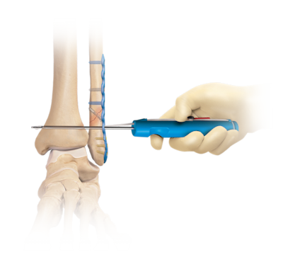 Syndesmosen-TightRope® XP-Implantatsystem