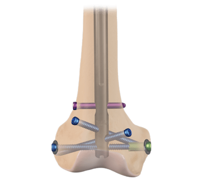 Sistema de clavos femorales