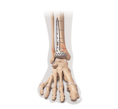 Internal Fixation for Distal Tibia Fracture/Pilon