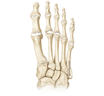 Metatarsal Fracture Repair