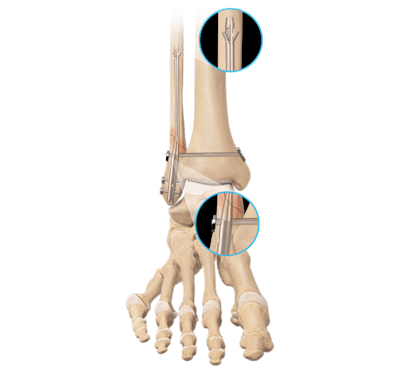 Ankle Fracture