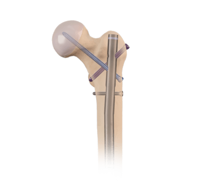 Femoral Nail System