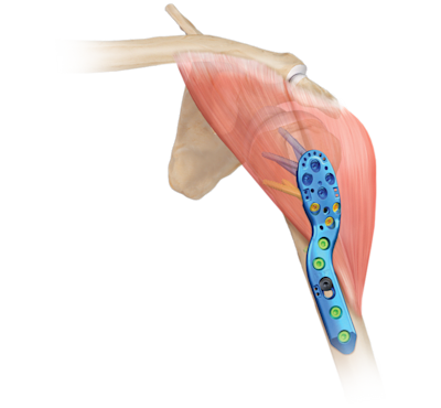 Humeral Plating System