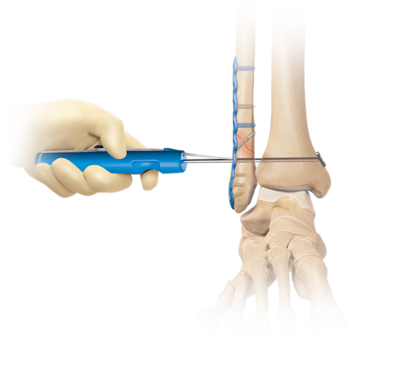 Syndesmosis TightRope<sup>®</sup> XP Implant System