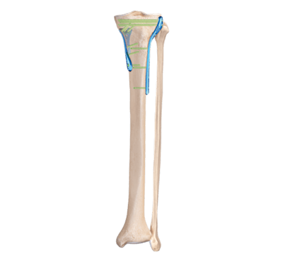 Sistema de placas de titânio tibial proximal