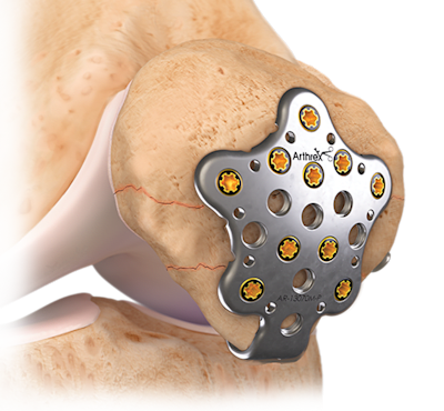 Patella SuturePlate™ II