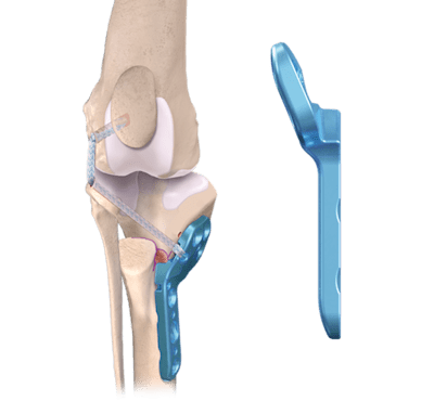 OrthoLine™ Medial Patella Luxation (MPL) System