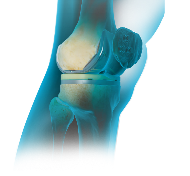 Artroplastia total de joelho – Primária