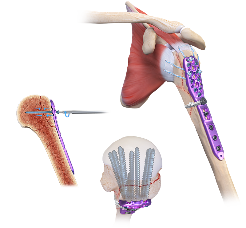 Arthrex Proximal Humeral Plating System