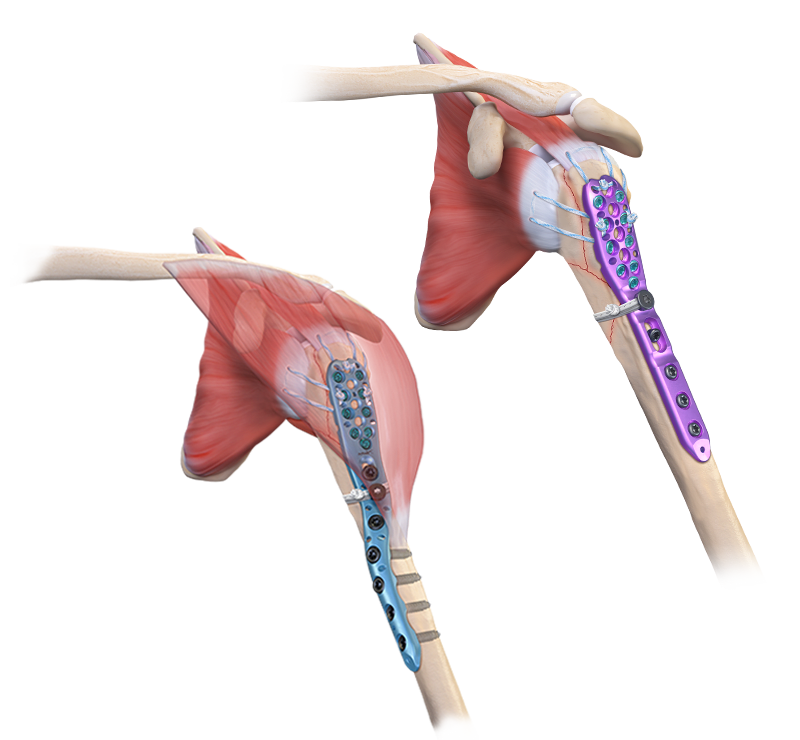 Plattensystem für den proximalen Humerus von Arthrex